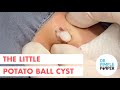 The Little Potato Ball Cyst