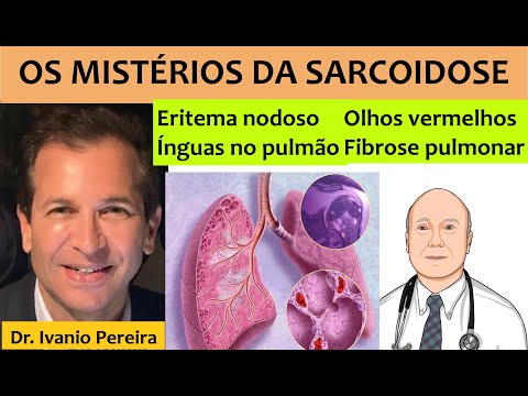 Vídeo: Você emagrece com sarcoidose?