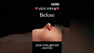 뭉뚝한 코끝에서높고 날렵한 코라인으로 교정! #아너스티성형외과 #코재수술 #코재수술후기 #코재수술잘하는곳  #코재수술전문 #코수술전후 #코재수술 #rhinoplasty