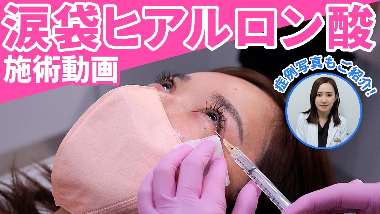 【症例写真あり】涙袋のヒアルロン酸注入！施術シーンを公開します！【東京イセアクリニック】