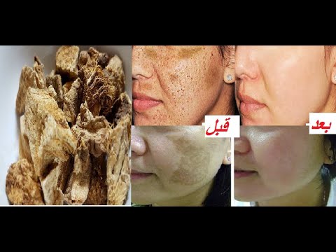 وصفة الداد الصحراوية لتبييض الوجه و ازالت الكلف من أول استعمال