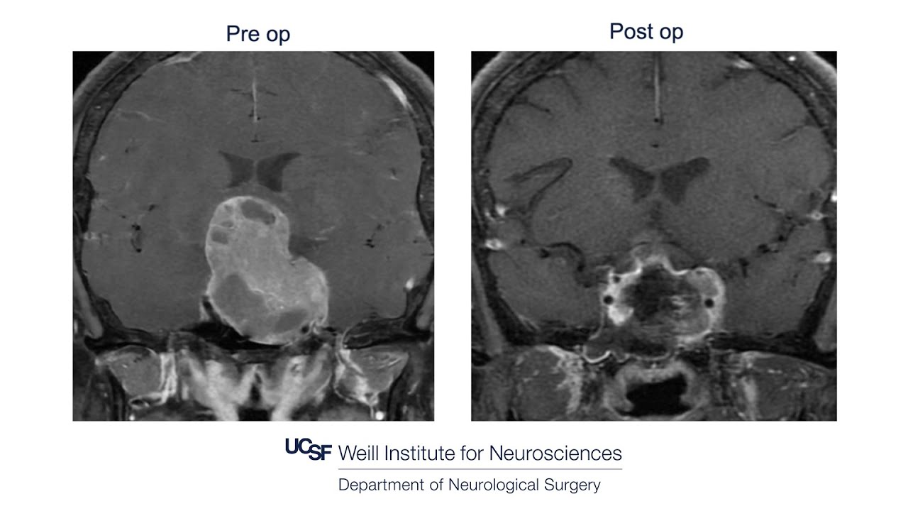 Endonasal endoscopic approach for a gigantic pituitary adenoma
