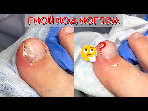 Гной под ногтем 😮 Вросший ноготь на ноге