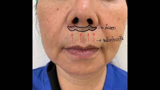 Upper lip lift ผ่าตัดยกริมฝีปากบน หมอเปิ้ล