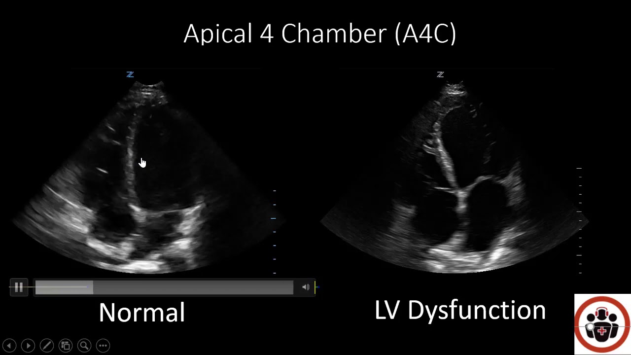 POCUS Cases 3: LV Systolic Dysfunction 