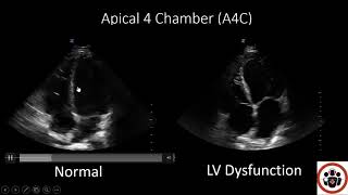 POCUS Cases 3: LV Systolic Dysfunction
