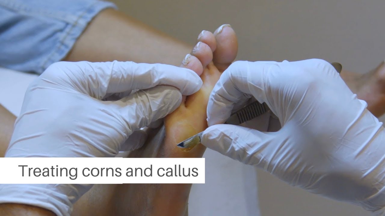 Callus and Corn removal at Flawless Feet Podiatry in London - YouTube