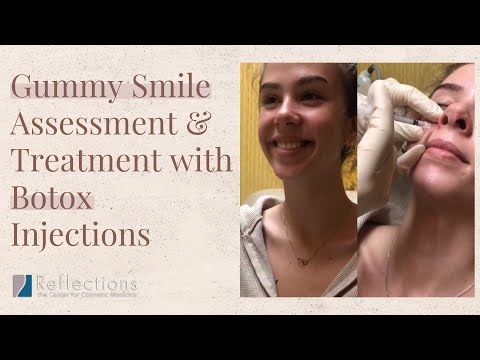 See My Whole Gummy Smile Botox Treatment: Assessment, Injection, & Results!