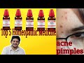 पिंपल्स की पांच बेहतरीन होम्योपैथिक दवा ! Top 5 Homepathic medicine for acne & pimples ?