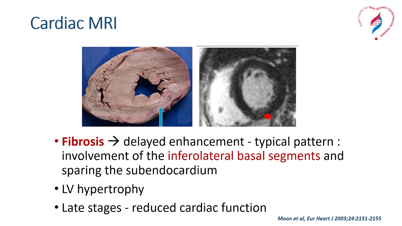 ERN GUARDHeart Educational Video Fabry's Cardiomyopathy YouTube