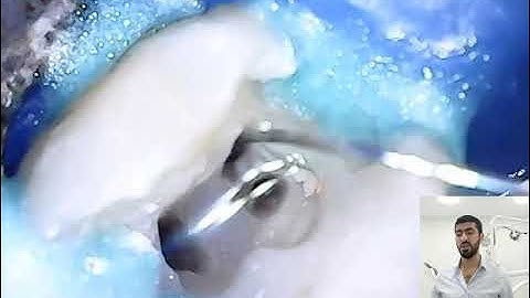 calcium hydroxide removal. Dr Malek Ashkar