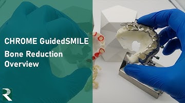 Bone Reduction Overview for a CHROME GuidedSMILE Natural FP1 Prosthetic Case
