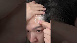 acne care routine that clears acne without living scars #skincare #koreanskincare  #acne #kbeauty
