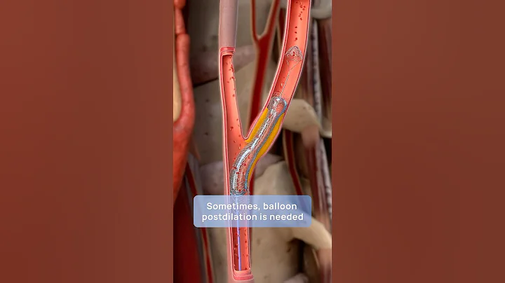 How carotid stenting prevents stroke: a step-by-step 3D guide to restoring blood flow