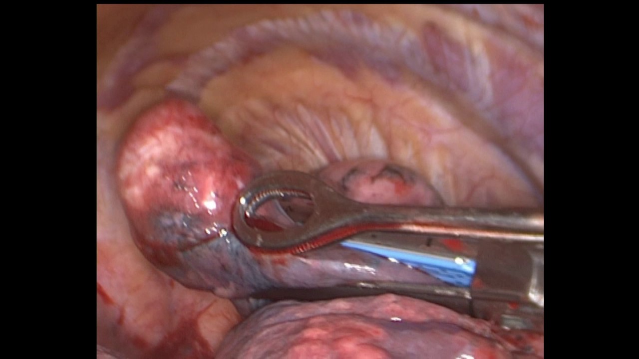 Фиброма легкого. Пациент 1006482.