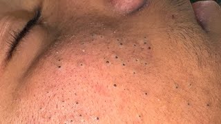 Deep Pore Cleansing Routine | Korean Skincare Solutions For Blackheads Removal