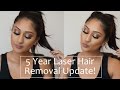 5 Year Full Body Laser Hair Removal Update! | Makeup By Megha