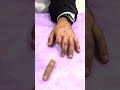 Mükemmel bir protez teslimi daha gerçekleştirdim 🤩🤩 #siliconefinger #fingerprosthetic #parmak