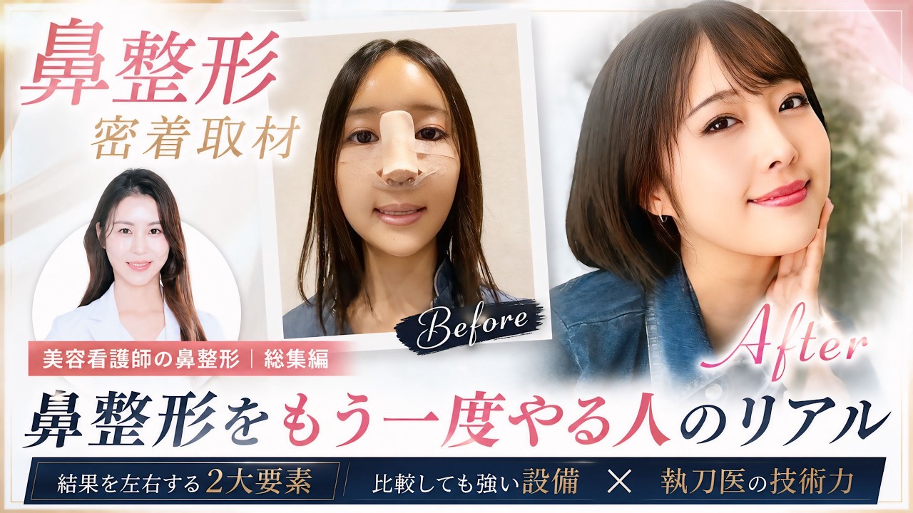 Nose Surgery] Revealing the Reality Three Months After Nose