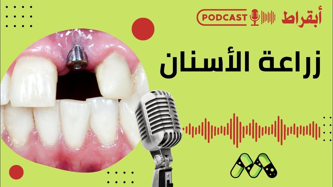 زراعة الأسنان خطوة بخطوة: كل ما تحتاج معرفته قبل اتخاذ القرار