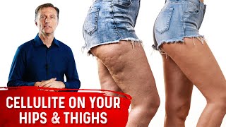 How To Get Rid Of Cellulite On Thighs & Buttocks? - Dr.Berg