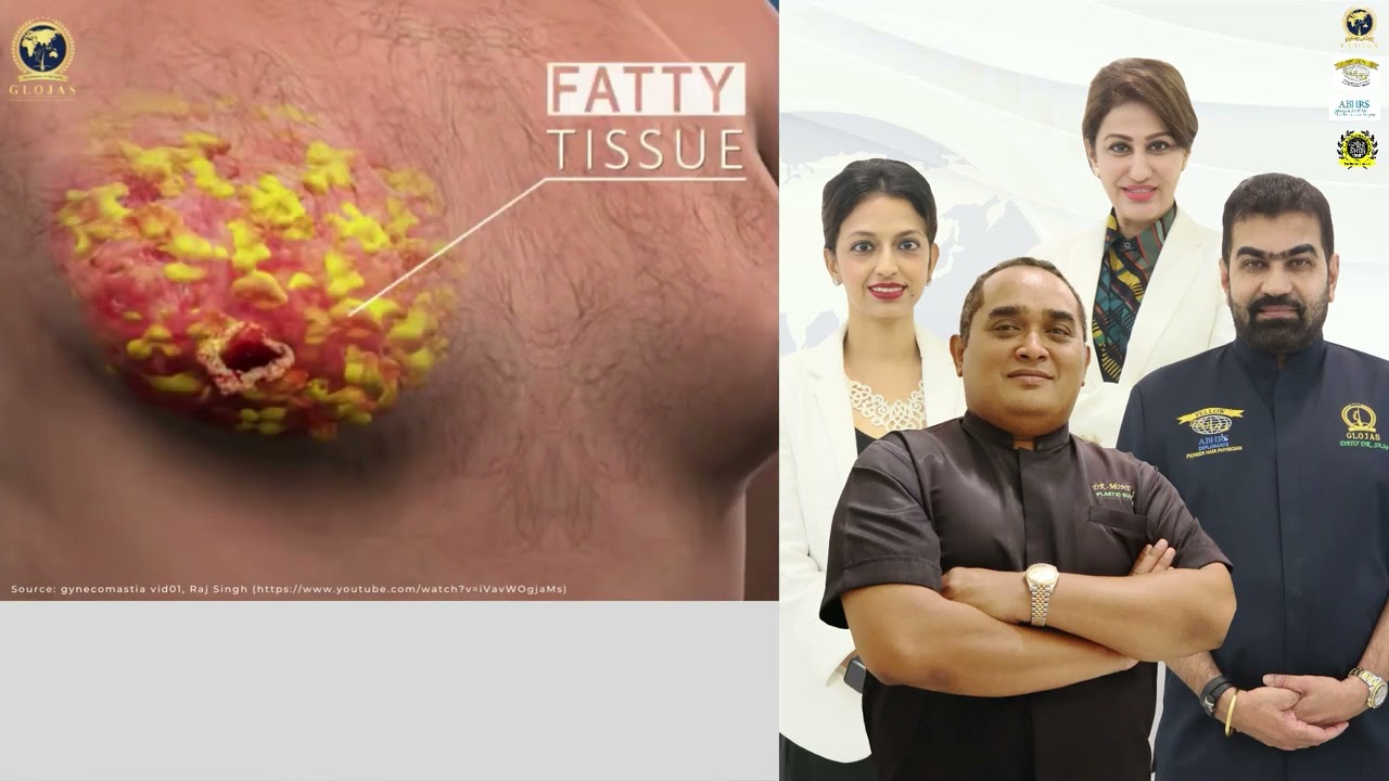 Gynecomastia Treatment Explained | Glojas Aesthetic Clinic