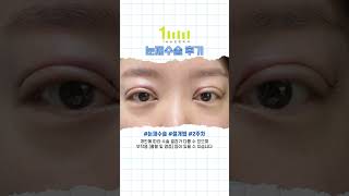 절개 눈재수술 후기