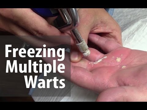 Freezing Multiple Warts | Utah Valley Dermatology