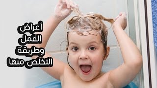 أعراض القمل وطريقة التخلص منها