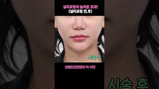실리프팅의 놀라운 효과 (실리프팅전,후)!? #올리고당 #실리프팅#박수연원장