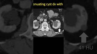 simple renal cyst
