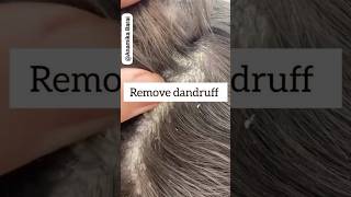 Remove Dandruff Just In 1 Wash#dandruff #haircare #hairfall #hairgrowth #viral #1m #short #shorts