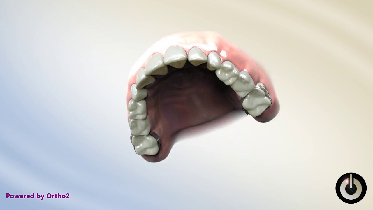 Pendulum Appliance Dental Braces Temecula Valley, CA YouTube