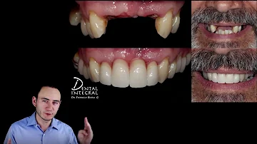 ¿Cuáles son los pros y los contras de los implantes dentales?