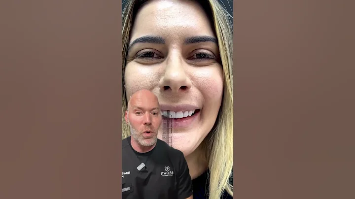 Gummy Smile Implant Solution?! 😬 #shorts