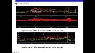 Sjögren Syndrome and the Autonomic Nervous System: When, How, What Now?