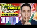 Желчекаменная болезнь. Холецистэктомия необязательна???