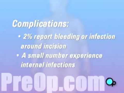 preop®-patient-education-gastric-bypass-laparoscopic-adjustable-band-surgery-2
