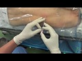 胸部硬膜外麻酔 thoracic epidural anesthesia by Dr.EpiCal （Action Cam）