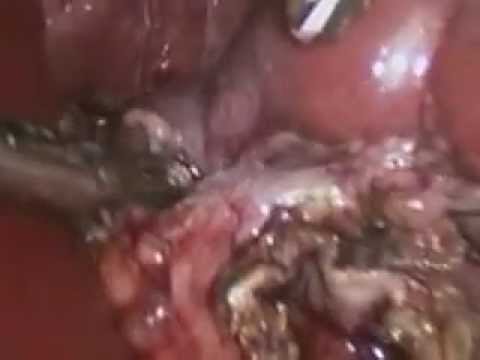 Lap heminephrectomy: Removal of nonfunctioning half of kidney causing recurrent UTI