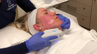 Ultherapy for Lifting &amp; Tightening | La Jolla Cosmetic Laser Clinic
