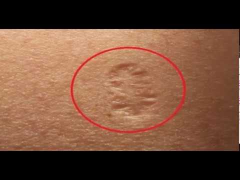 Знаете ли вы всю правду О ШРАМЕ на верхней ЛЕВОЙ РУКЕ и его значении?! Знаете ли вы всю правду О ШРАМЕ на верхней ЛЕВОЙ РУКЕ и его значении?!