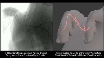 [Telerobotic Stroke Intervention] Supporting Movie S6