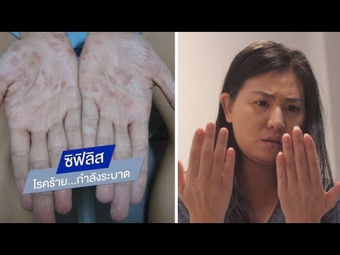 ซิฟิลิส โรคร้าย...กำลังระบาด | พบหมอมหิดล [by Mahidol Channel]