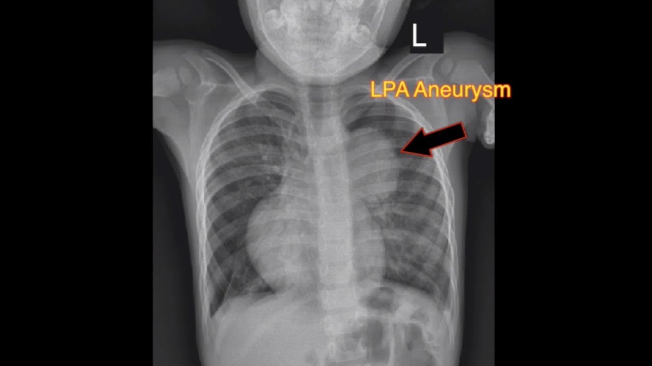 TOF Absent Pulmonary Valve Syndrome YouTube