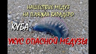 КУБА. НАШЕСТВИЕ ОПАСНЫХ МЕДУЗ НА ПЛЯЖАХ ВАРАДЕРО. УКУС МЕДУЗЫ" ПОРТУГАЛЬСКИЙ КОРАБЛИК". КУБА. НАШЕСТВИЕ ОПАСНЫХ МЕДУЗ НА ПЛЯЖАХ ВАРАДЕРО. УКУС МЕДУЗЫ" ПОРТУГАЛЬСКИЙ КОРАБЛИК".
