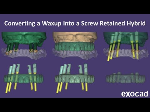 Converting a Waxup to a Hybrid in Exocad