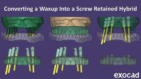 Converting a Waxup to a Hybrid in Exocad