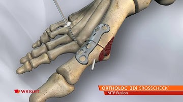 ORTHOLOC™ 3Di CROSSCHECK™ MTP Fusion Animation