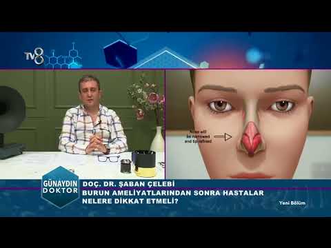 Doç. Dr. Şaban Çelebi | Burun ameliyatı | 20.12.2017 - YouTube